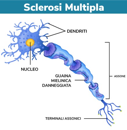 Danno alla mielina nella SM